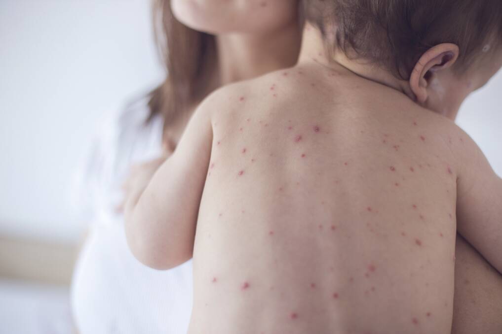 ALERT: Queensland Health has issued a health alert after a confirmed case of measles was diagnosed in a traveller who recently spent time in Brisbane, Logan and Beaudesert. Photo: Supplied.