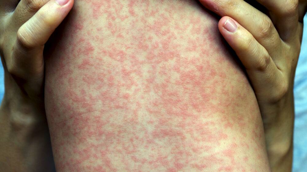 MEASLES: On rare occasion the disease can be fatal.