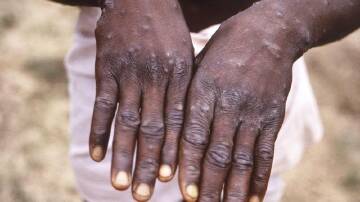 South Australian health officials have reported a first case of monkeypox in a returned traveller.