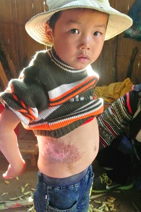 Young Vietnamese boy Thanh is recovering from skin graft surgery.